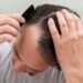 How Hair Transplant Restores Thinning Hair